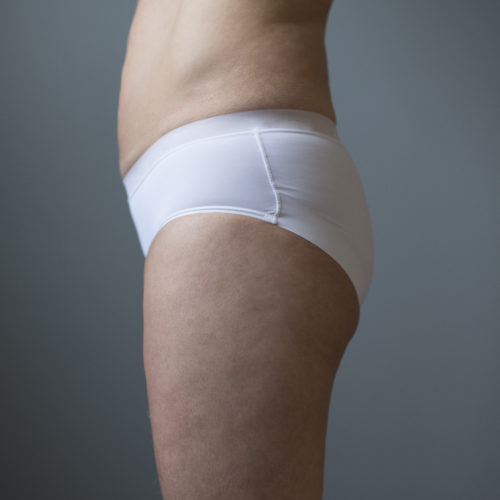 Fettsuging, liposkulptur, fettfjerning, figurforming hos Klinikk Trondheim, plastisk kirurgi