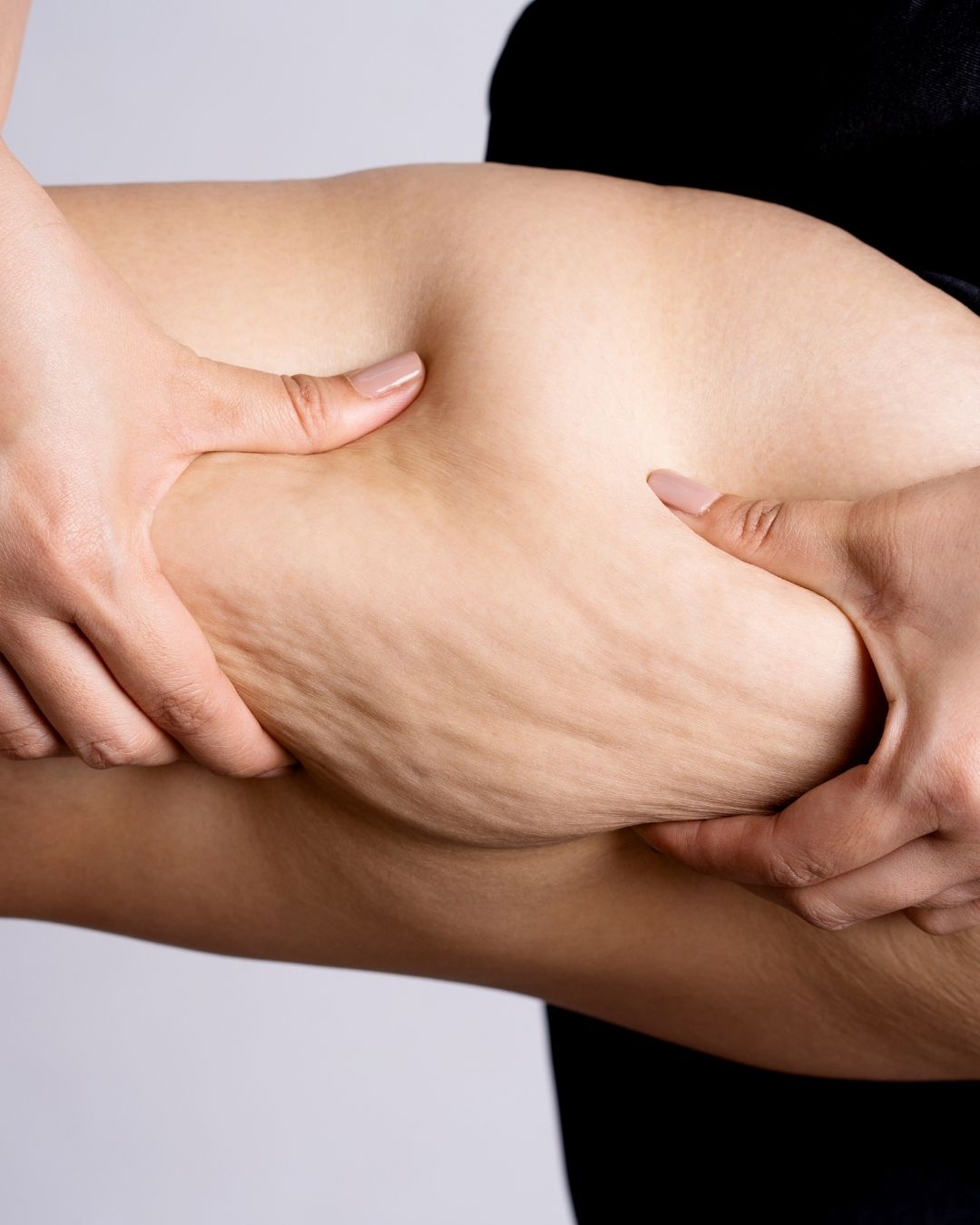 Lårplastikk-behandling-av-hudoverskudd-på-lårene