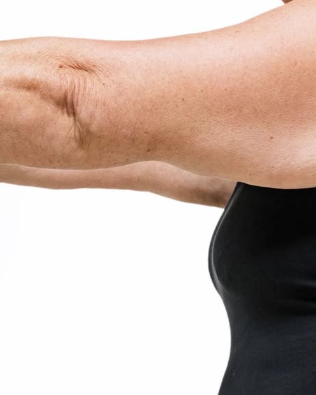 Armplastikk–reduksjon-av-hudoverskudd-på-overarmene