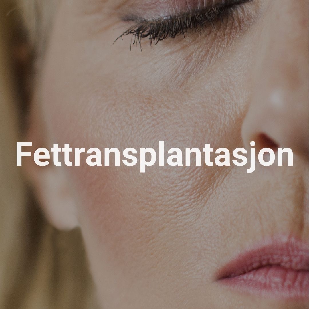 Fettransplantasjon