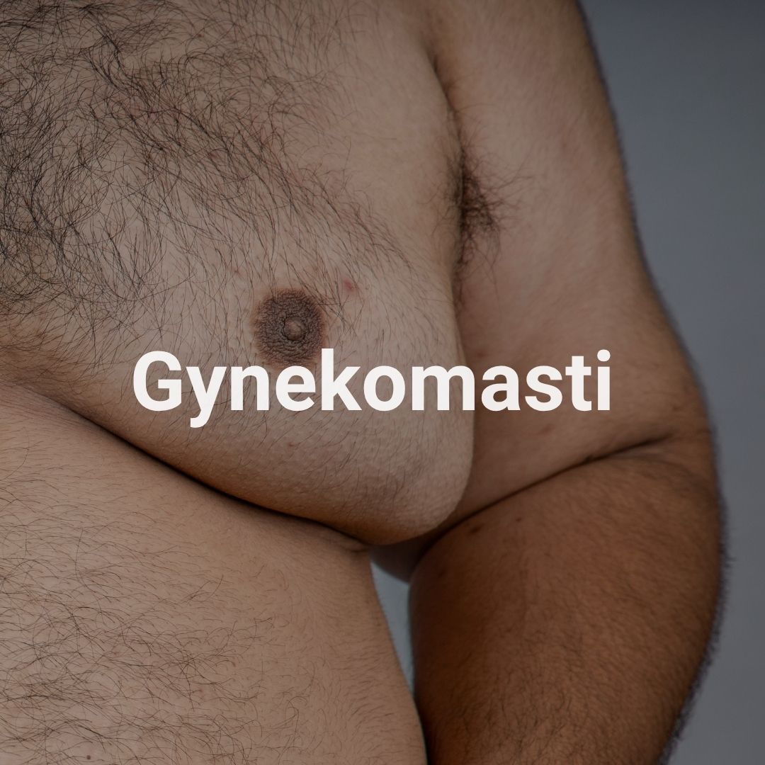Gynekomasti