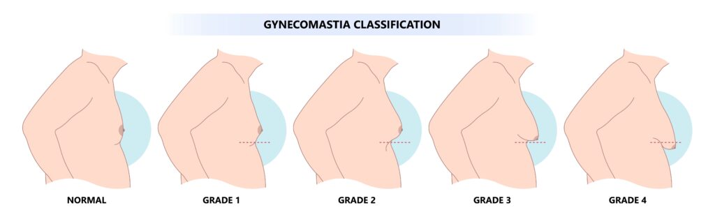 gynekomasti faser klinikk trondheim