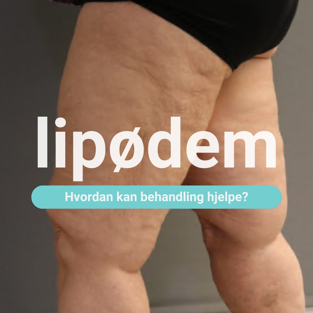 lipødembehandling i trondheim