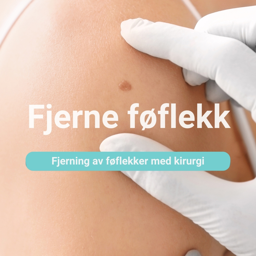 fjerne føflekk