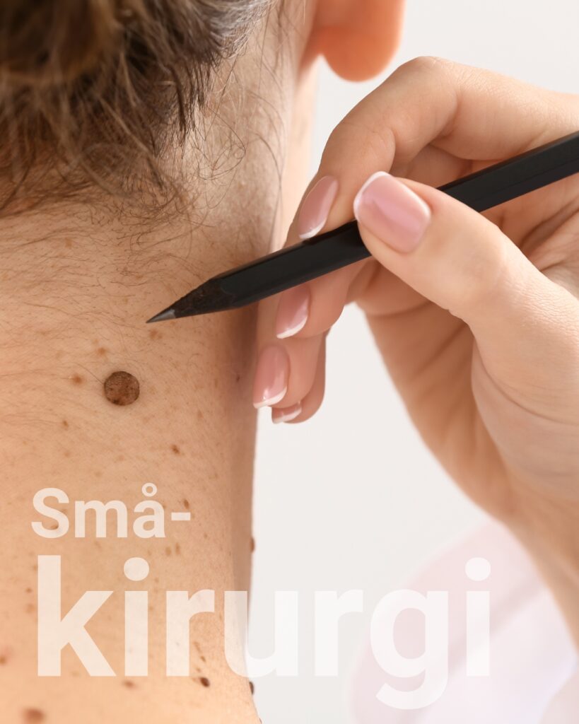 føflekk kirurgi klinikk trondheim
